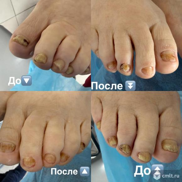 Педикюр для пожилых, аппаратный педикюр , педикюр эстетический.. Фото 6.